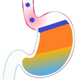 Альгинат натрия формирует на поверхности содержимого желудка нерастворимый гелевый барьер